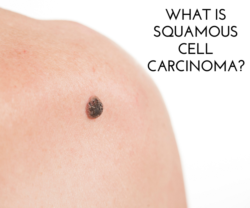 What is Squamous Cell Carcinoma?