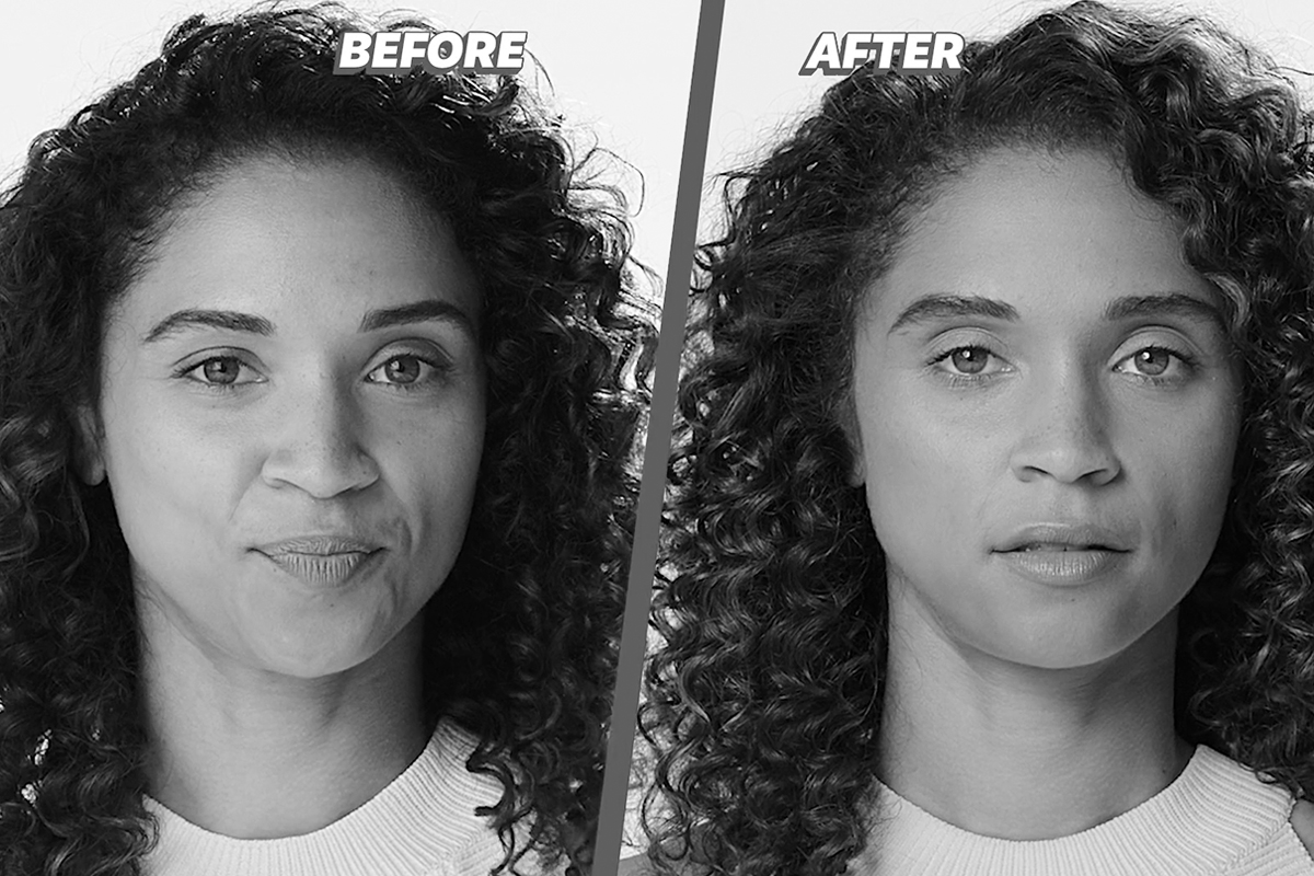 Before and after receiving Juvederm in Gloucester County
